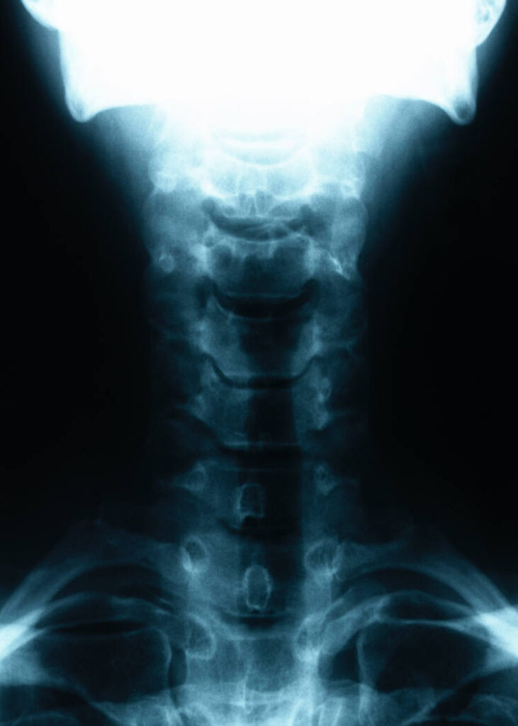 upper spine